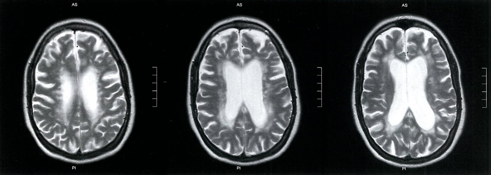 Multiple sclerosis; baseline images (1/2)