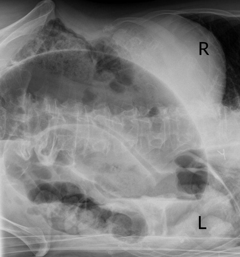 Coffee bean sign in sigmoid volvulus