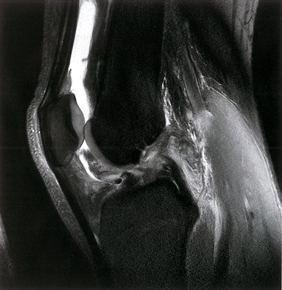 Anterior cruciate ligament injury