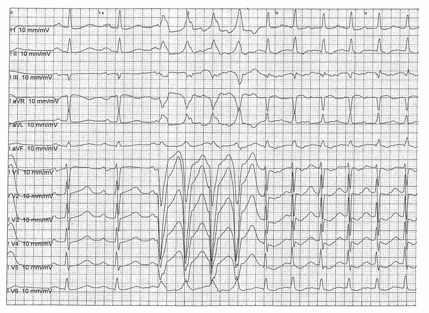 Ventricular and supraventricular tachyarrhythmia