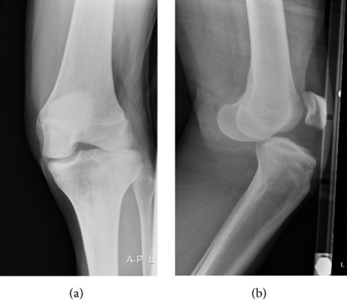 Rotatory anterolateral knee dislocation