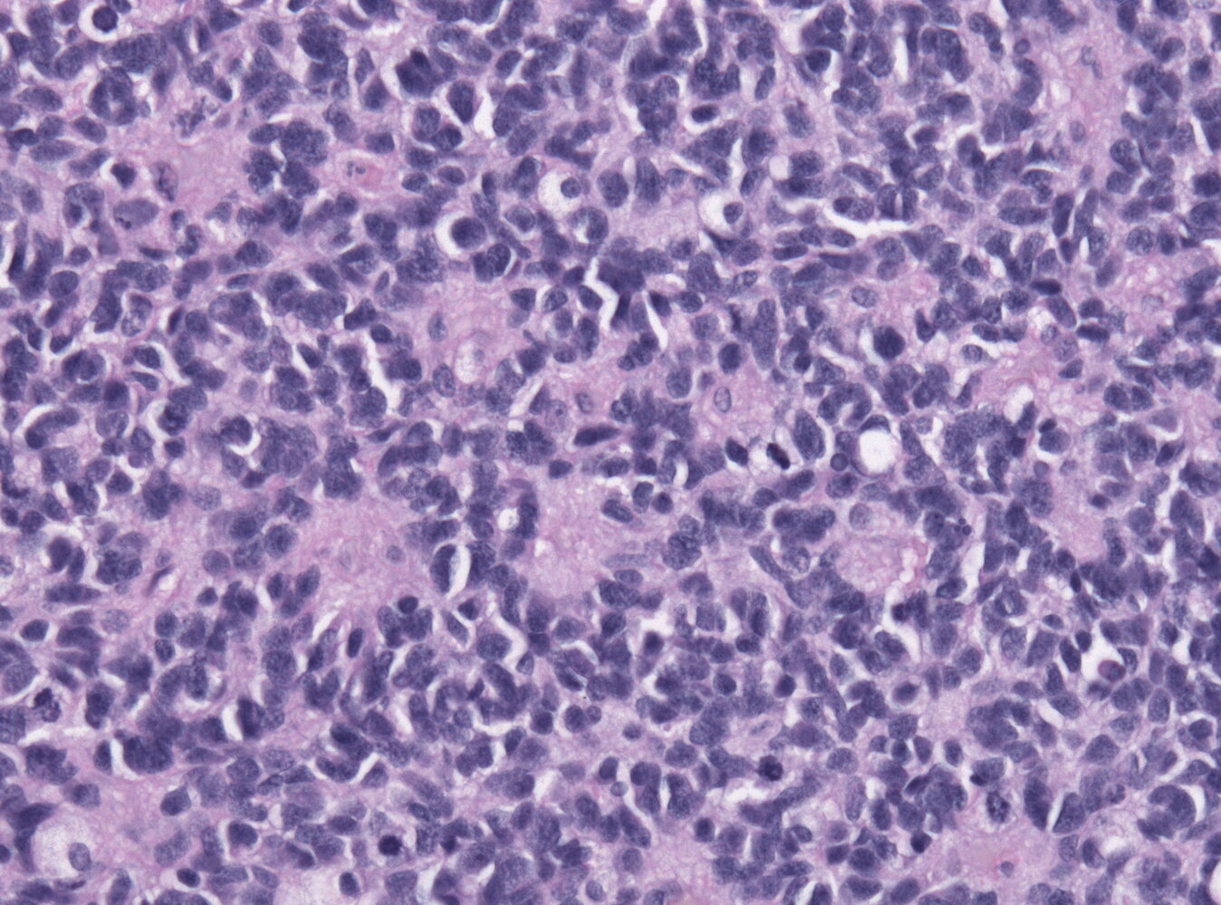 Medulloblastoma