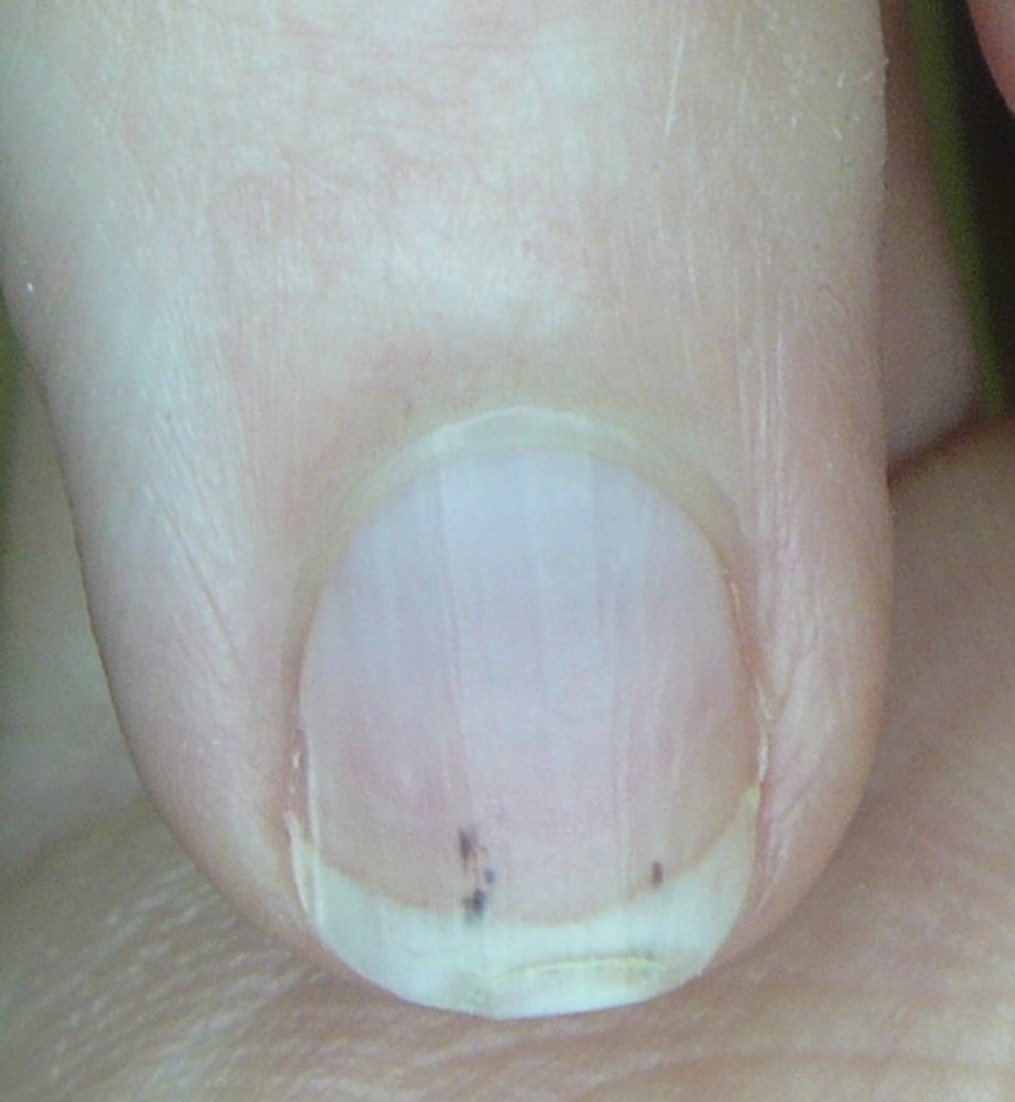Splinter hemorrhages in endocarditis