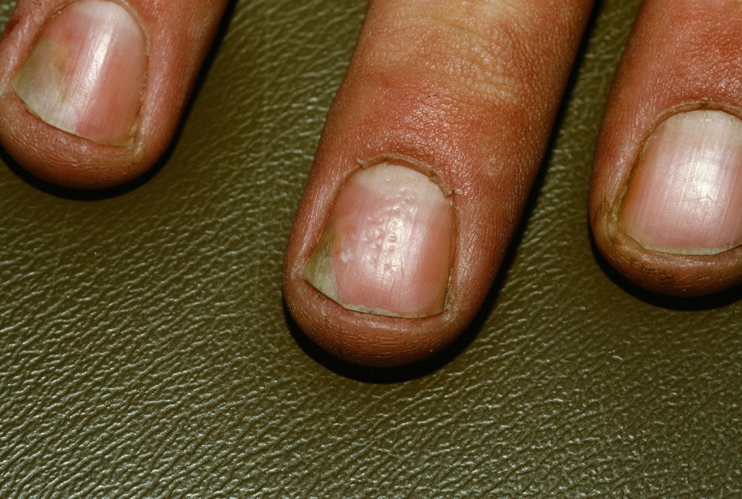 Nail pitting and onycholysis