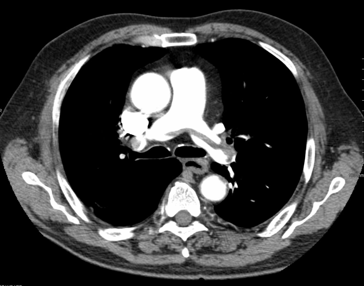Saddle pulmonary embolism