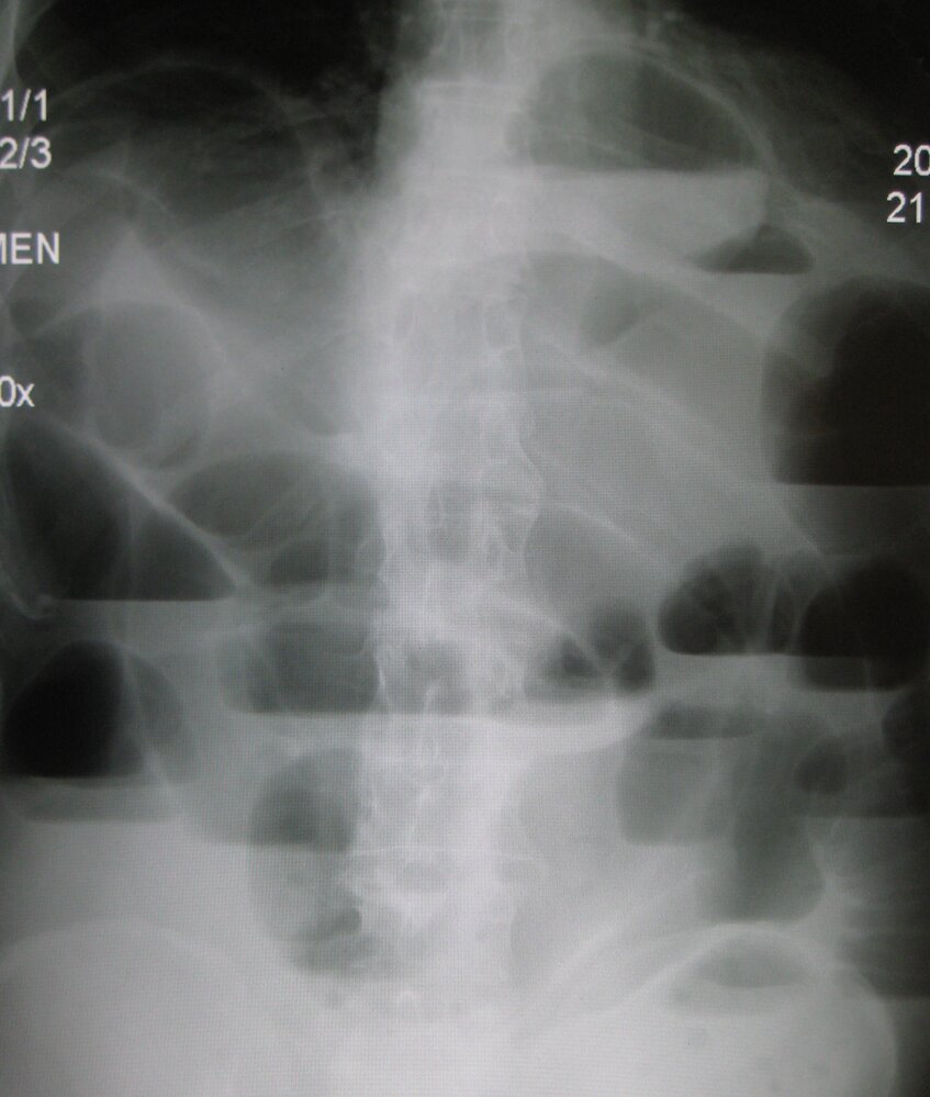 Small bowel obstruction