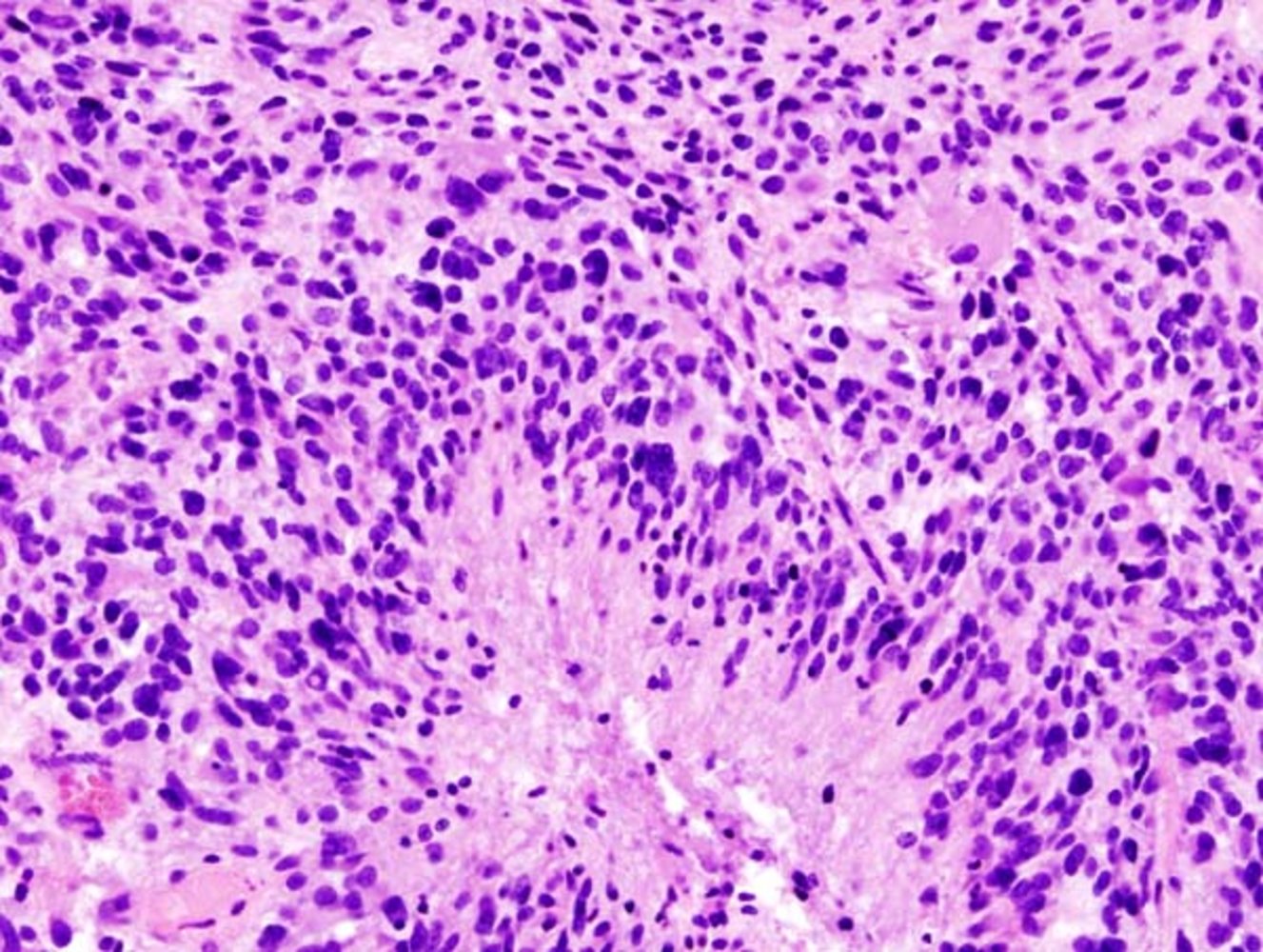 Glioblastoma multiforme