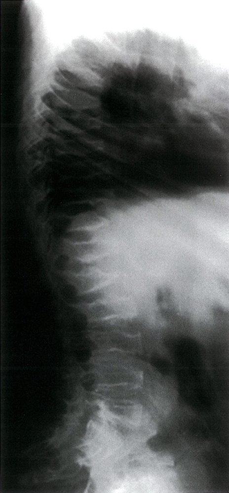 Achondroplasia