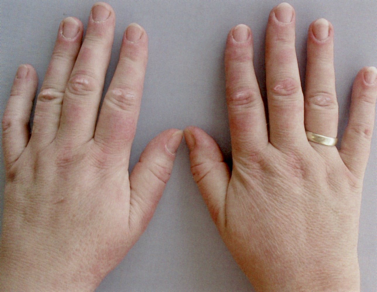 Gottron papules in dermatomyositis
