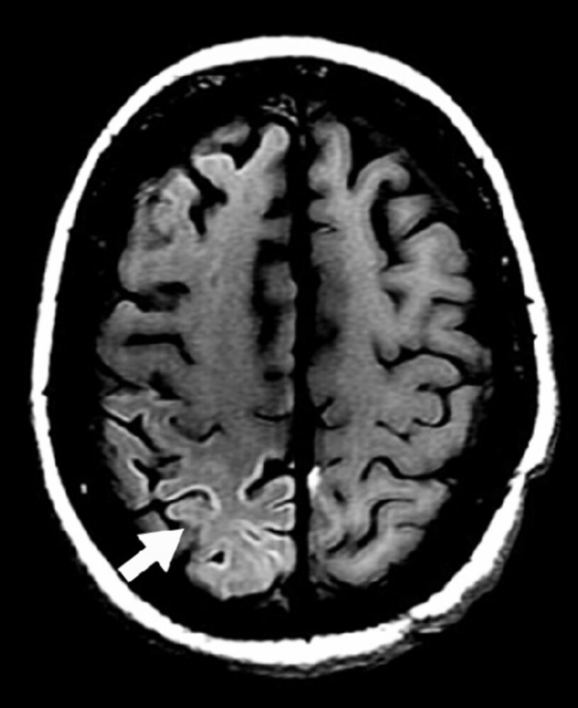 Cortical laminar necrosis