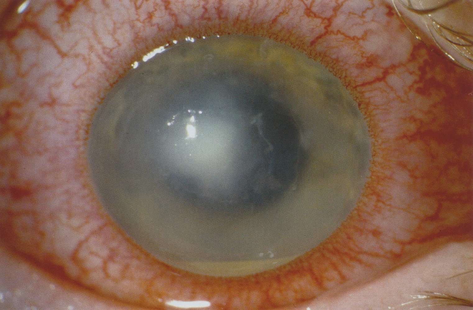 Infective keratitis