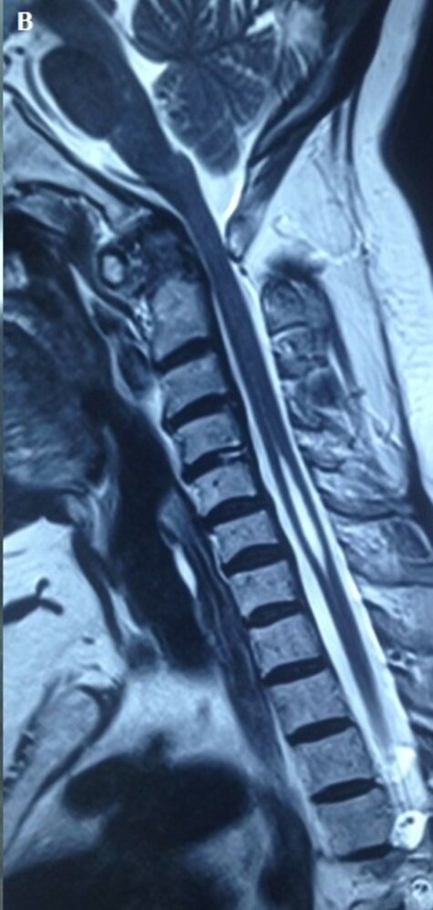 Atlantoaxial subluxation in rheumatoid arthritis