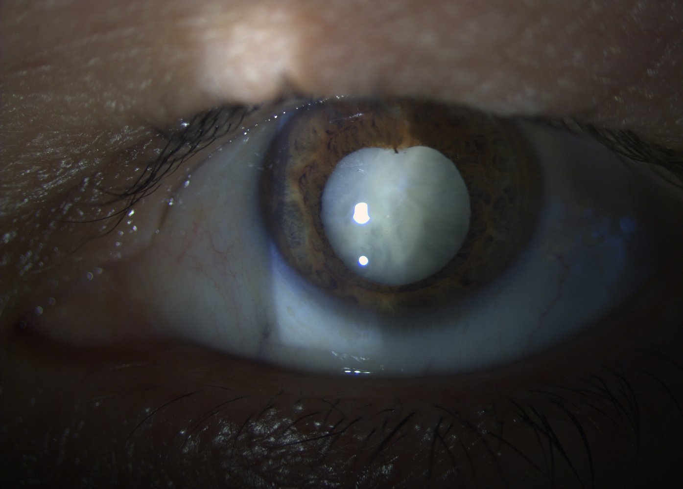 Mature cataract