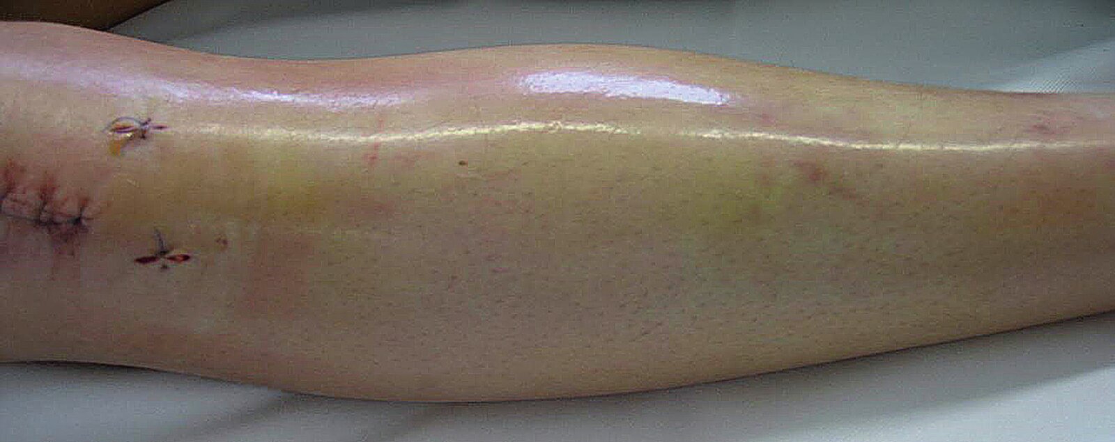 Compartment syndrome of the lower leg