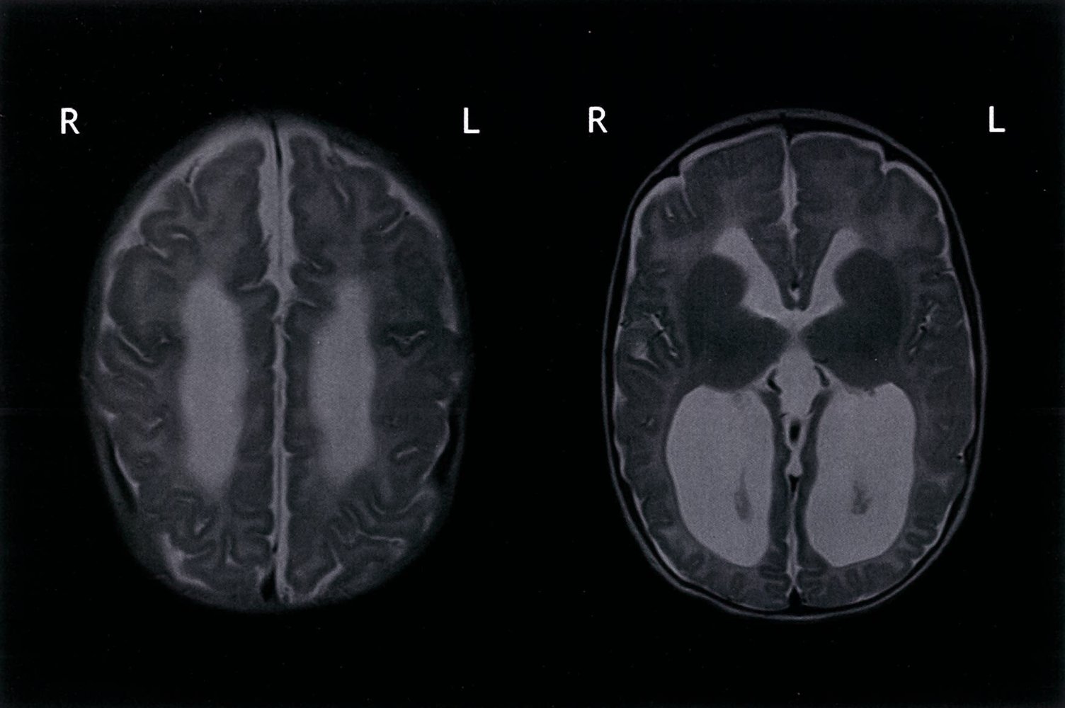 Noncommunicating hydrocephalus