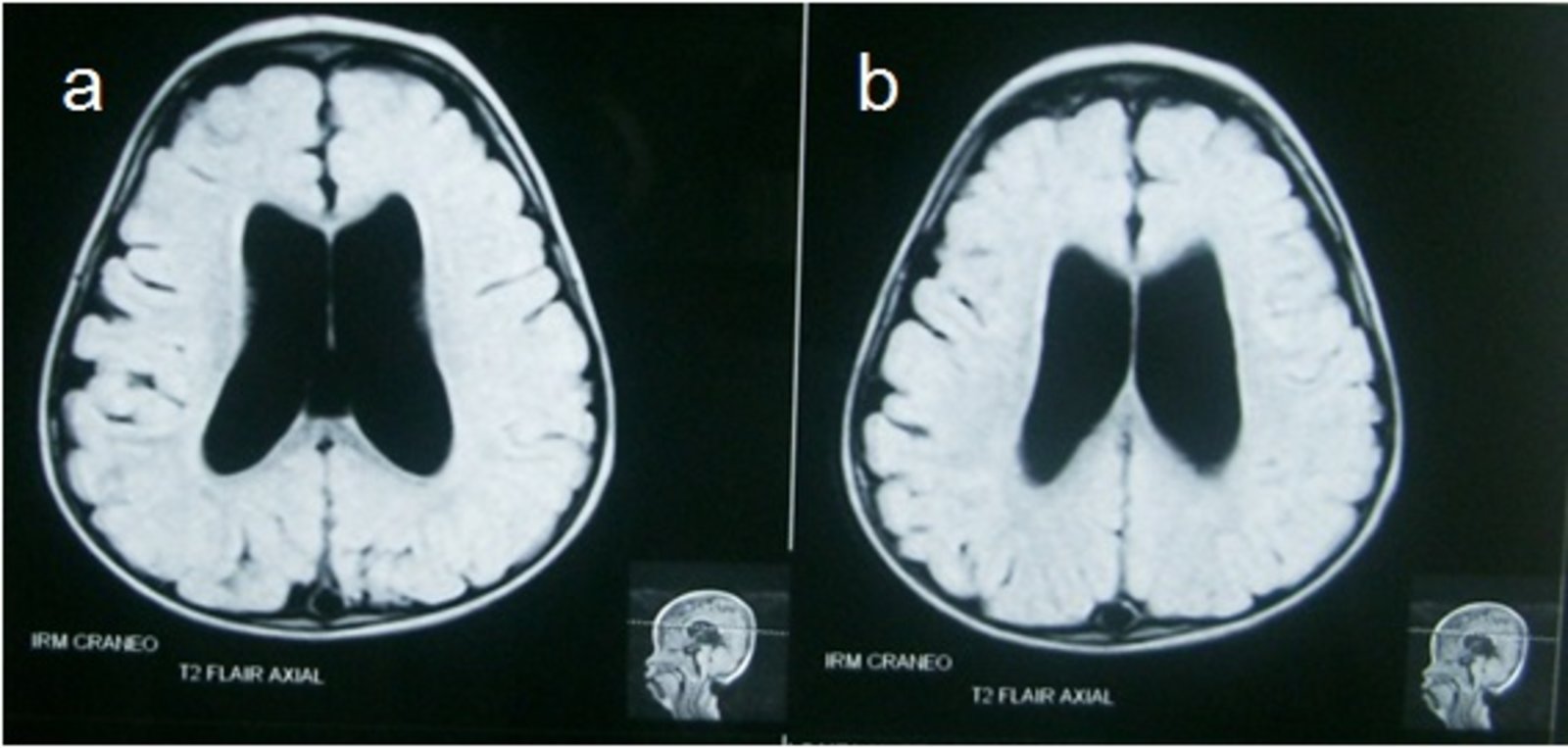 Hydrocephalus