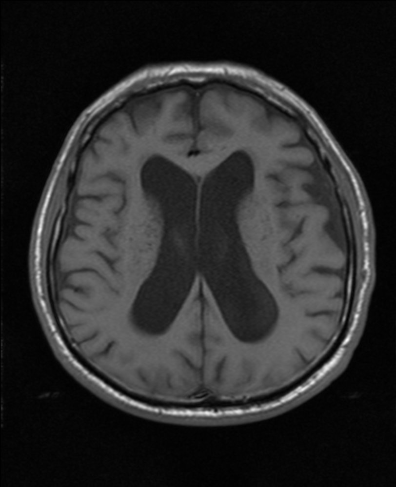 Normal pressure hydrocephalus
