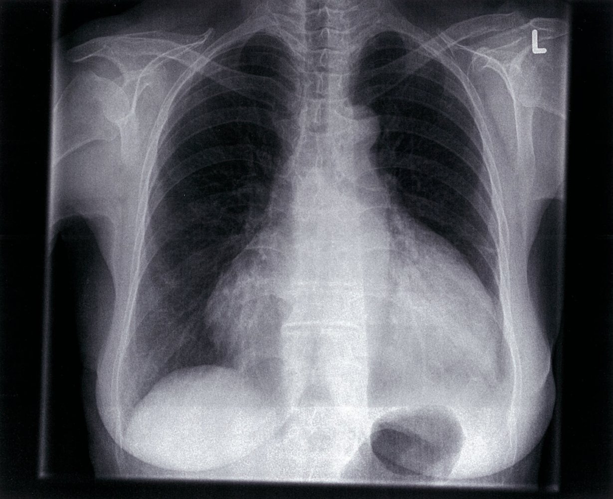 Pericardial effusion with water bottle configuration