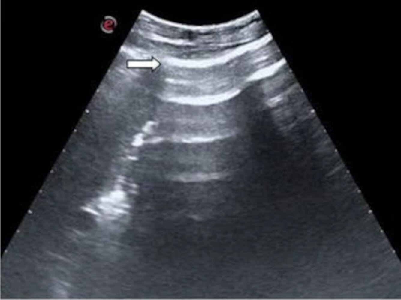 Enhanced peritoneal stripe sign