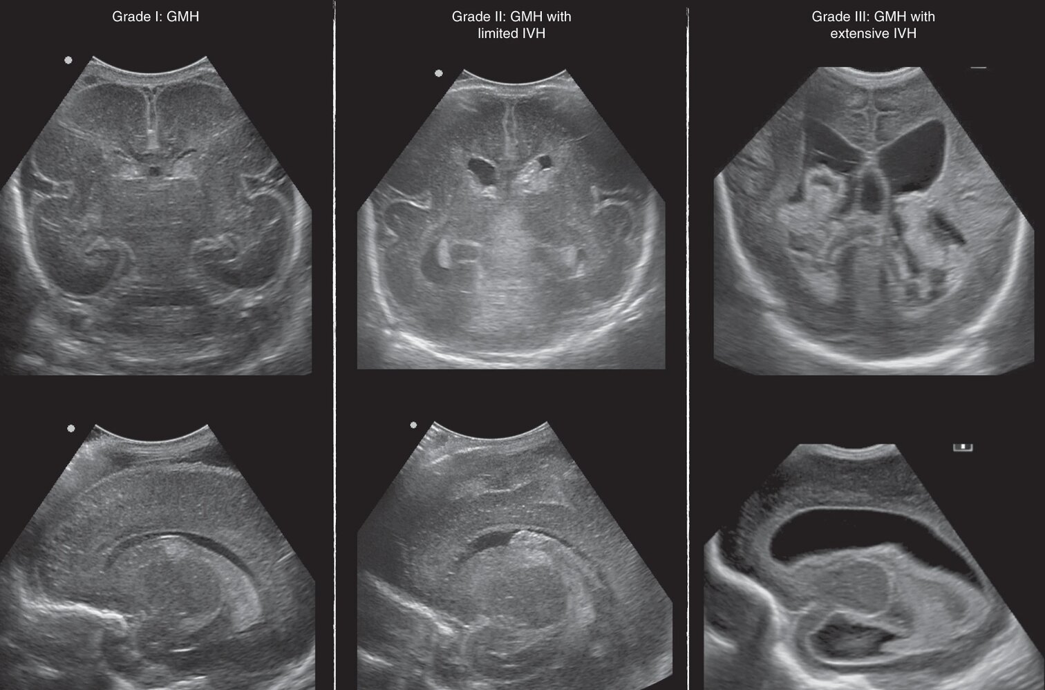 Neonatal intraventricular hemorrhage (IVH)