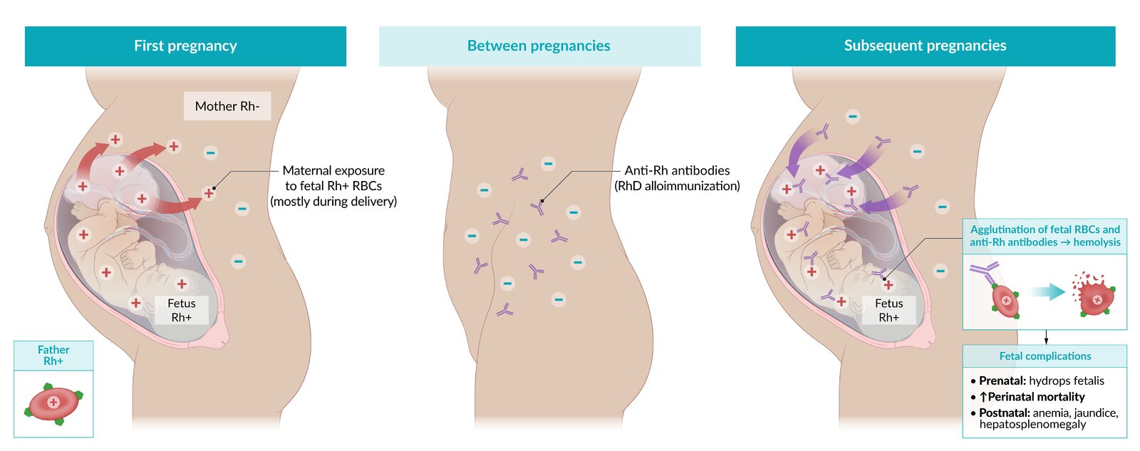 Rhesus (Rh) incompatibility in pregnancy