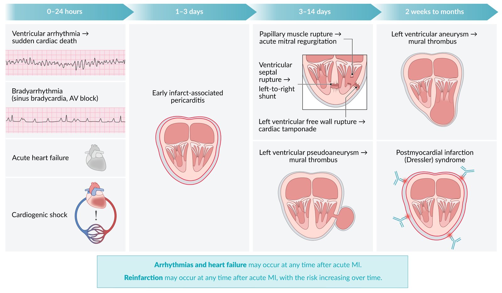 Timeline of most common post myocardial infarction complications
