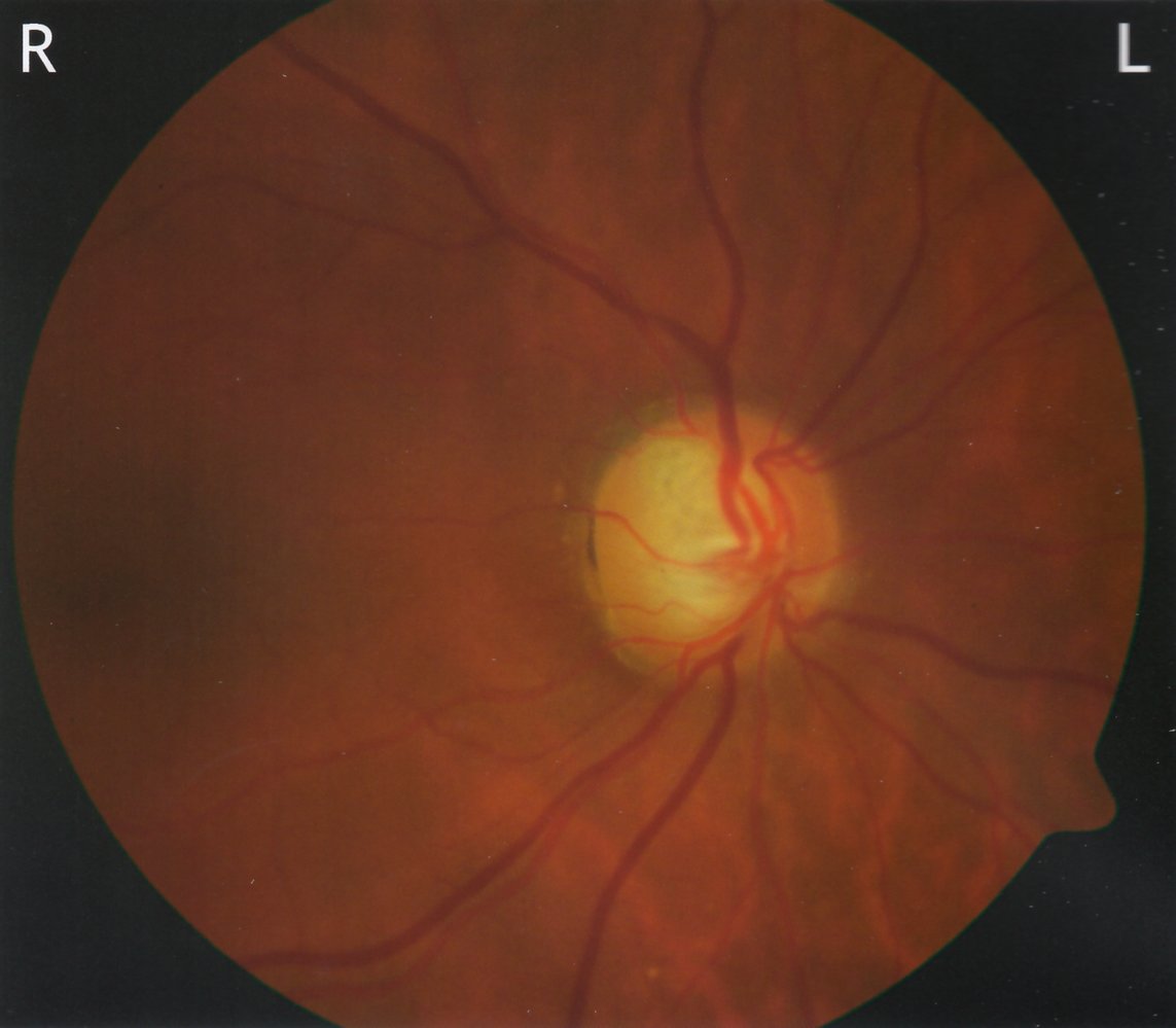 Glaucomatous excavation of the optic disc