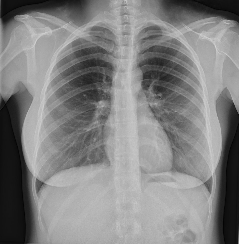 Normal posteroanterior (PA) chest radiograph