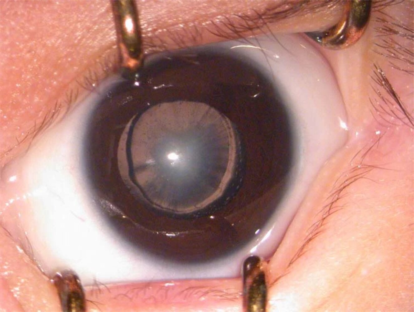 Congenital cataract