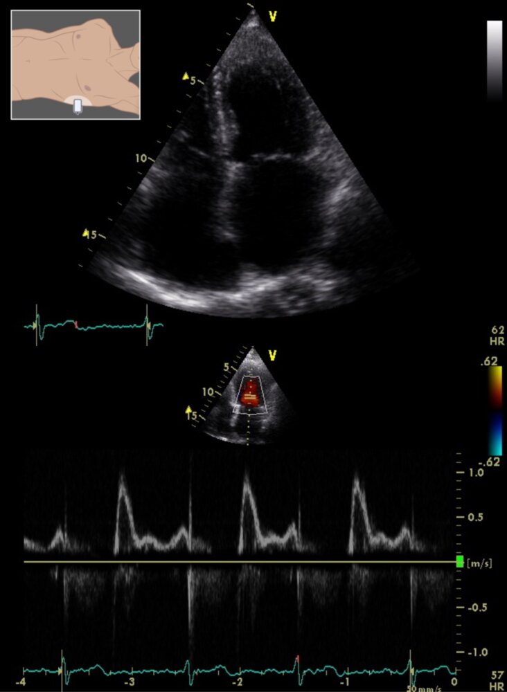 Restrictive cardiomyopathy