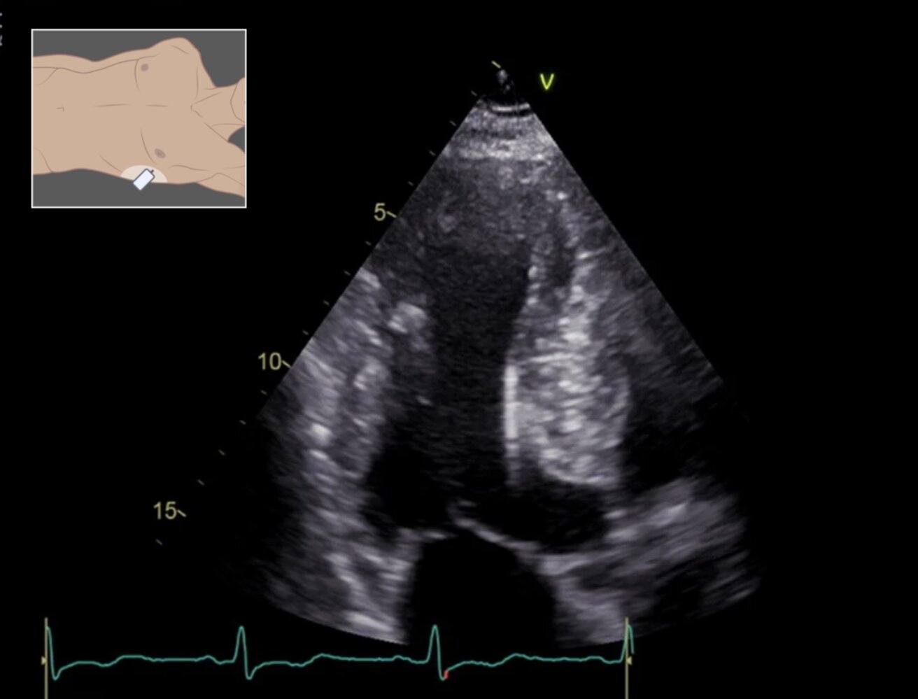 Hypertrophic cardiomyopathy