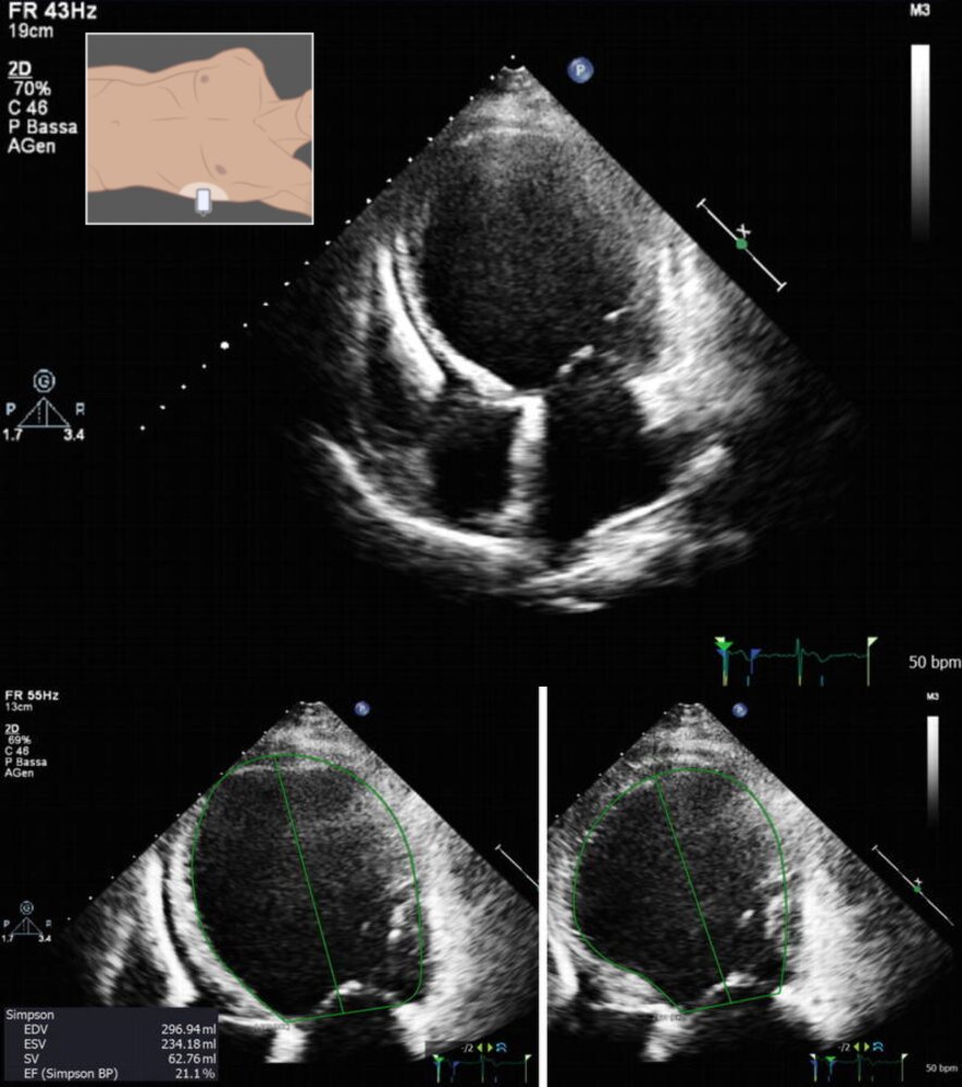 Dilated cardiomyopathy