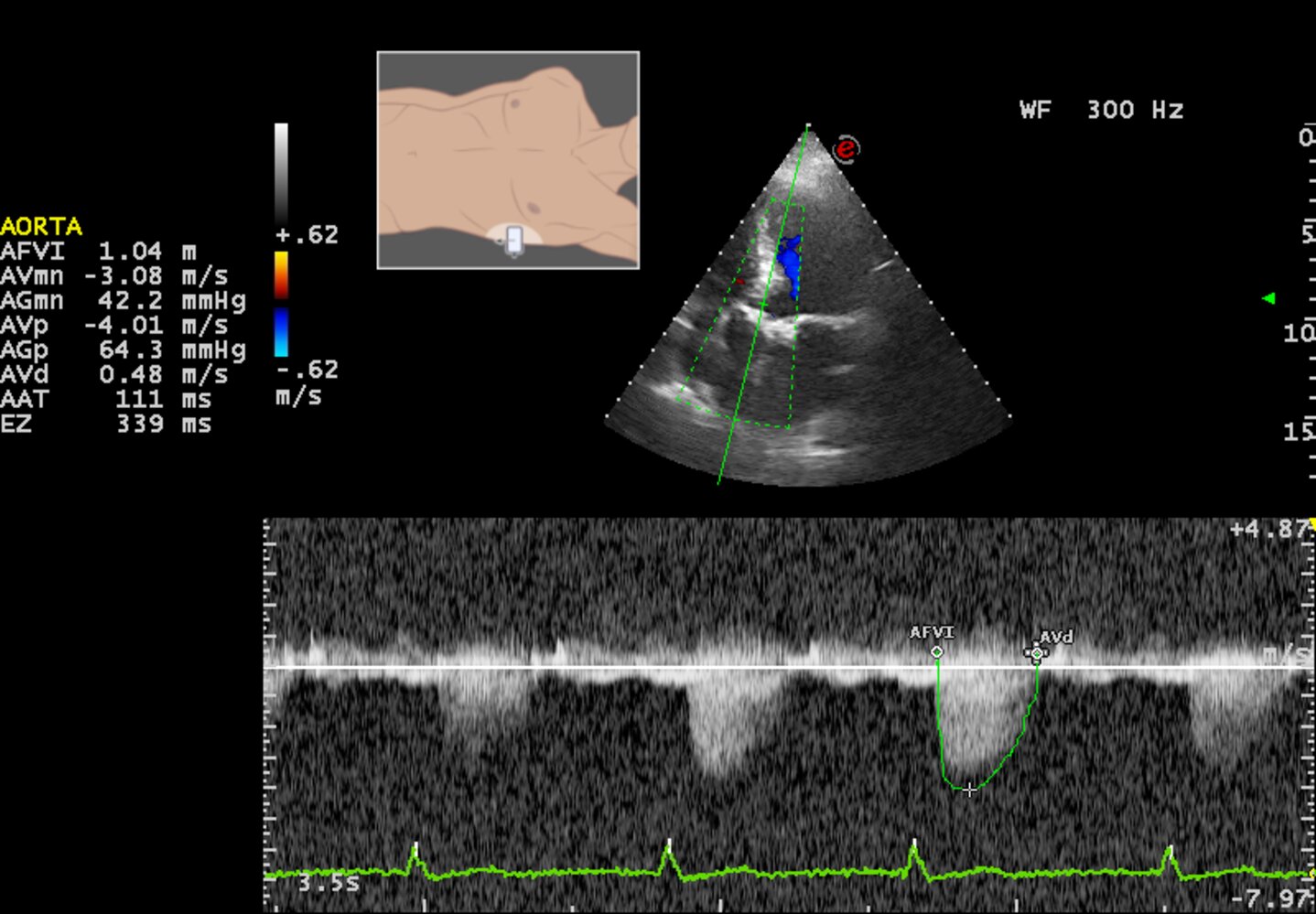 Continuous wave (CW) Doppler in aortic valvular stenosis