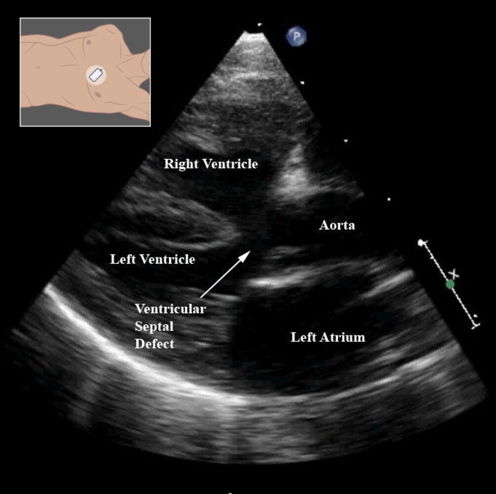 Tetralogy of Fallot