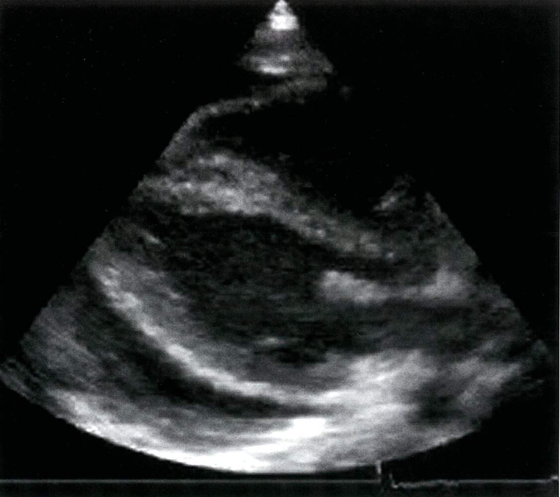Pericardial effusion
