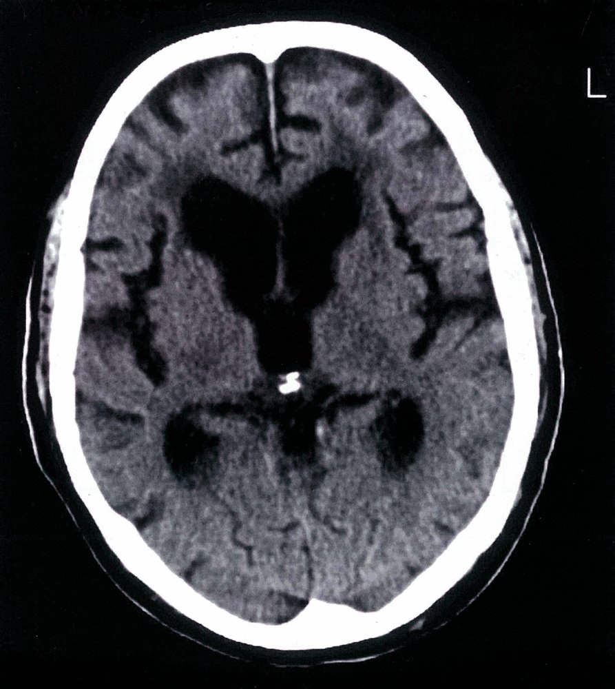 Normal pressure hydrocephalus
