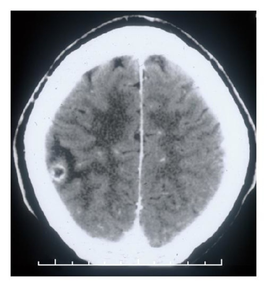 Ring-enhancing lesion in the brain