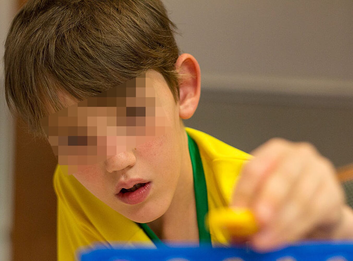 Fragile X syndrome