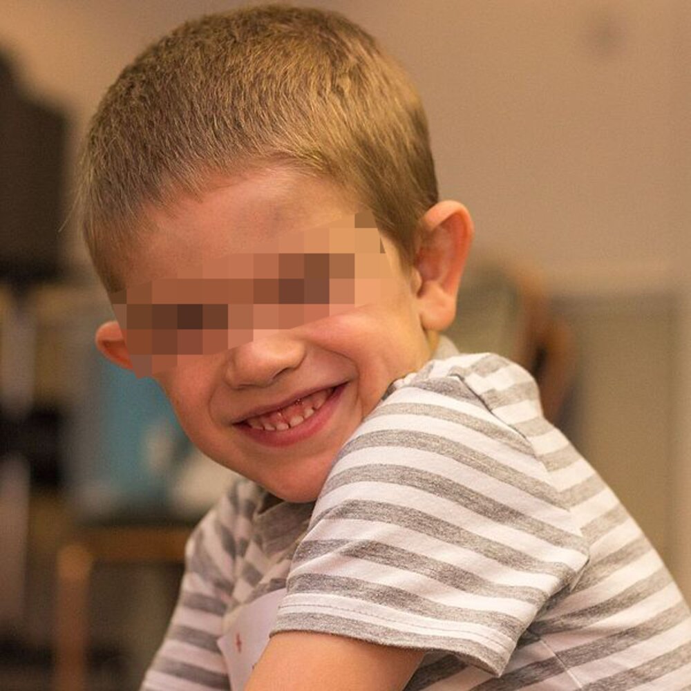 Facial features of Fragile X syndrome