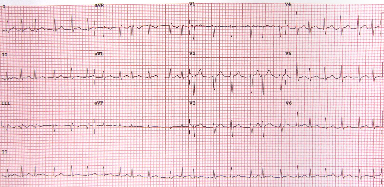 Atrial fibrillation with rapid ventricular response