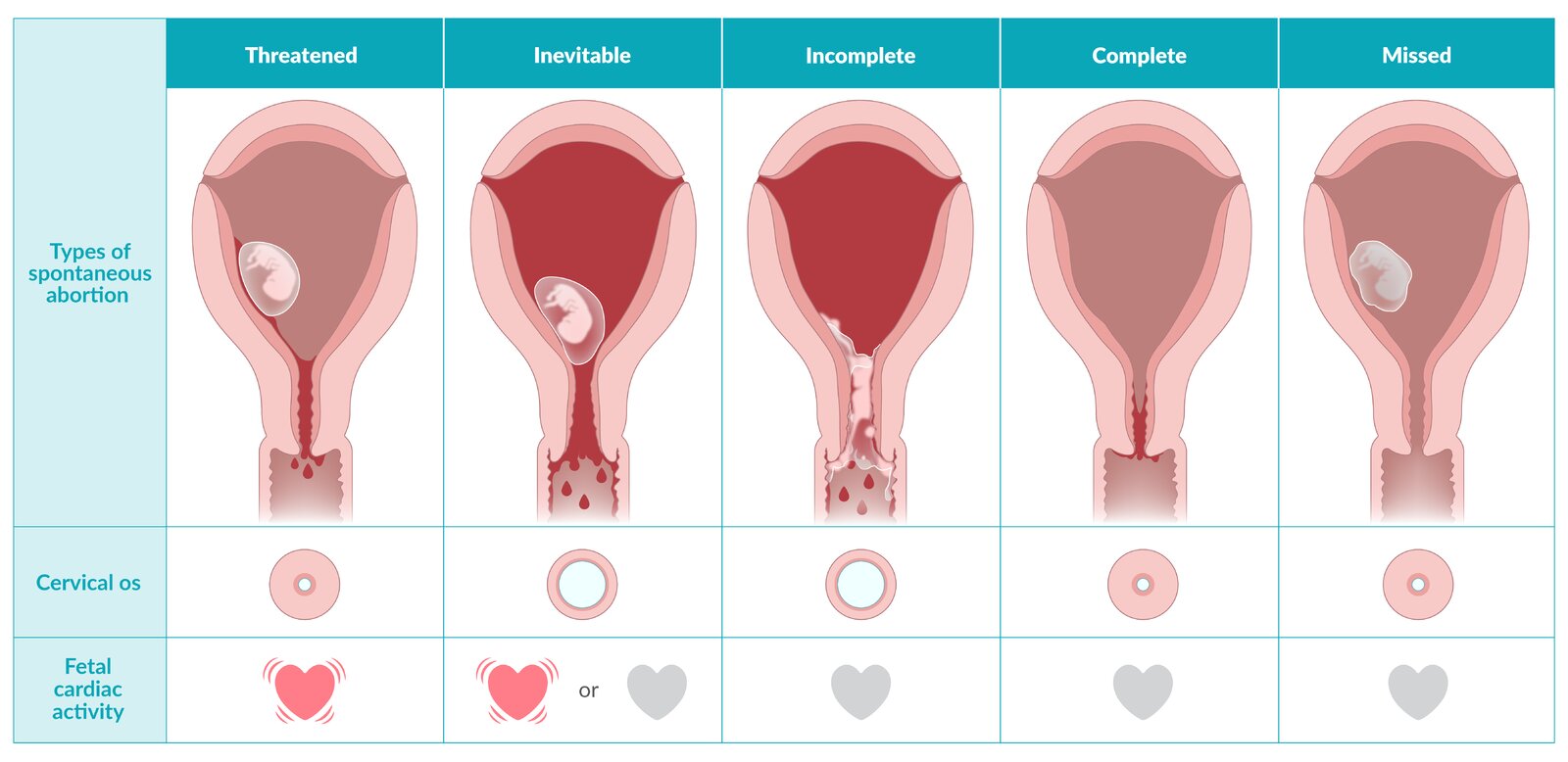 Types of spontaneous abortion