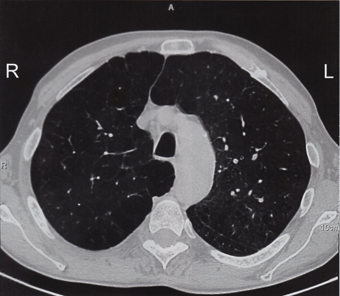 Panlobular pulmonary emphysema