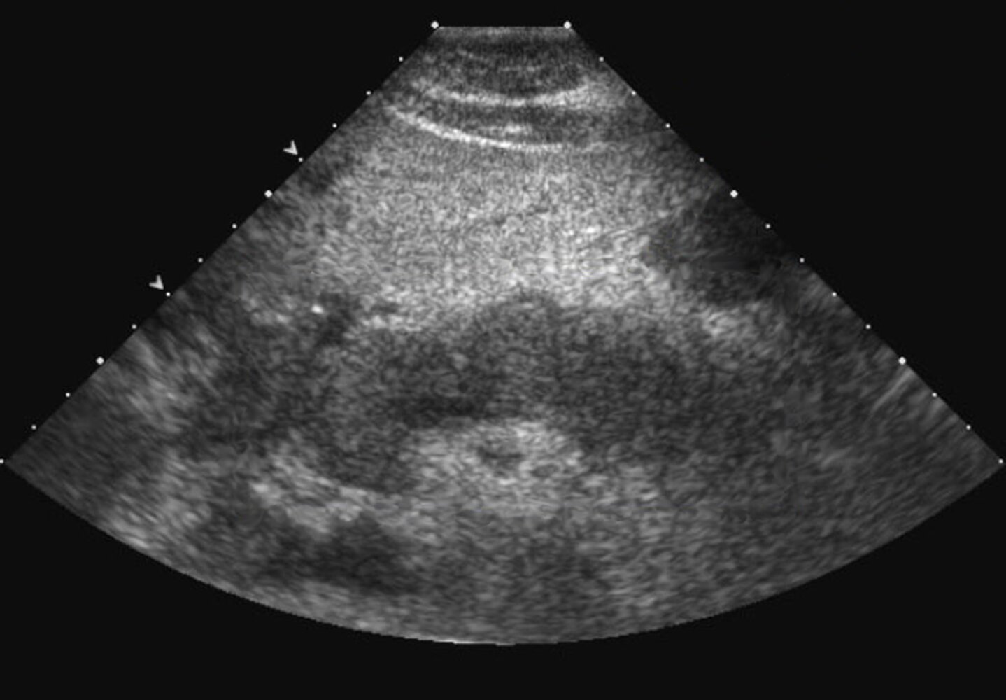 Hypoechoic pancreas in acute pancreatitis (interstitial edematous pancreatitis)