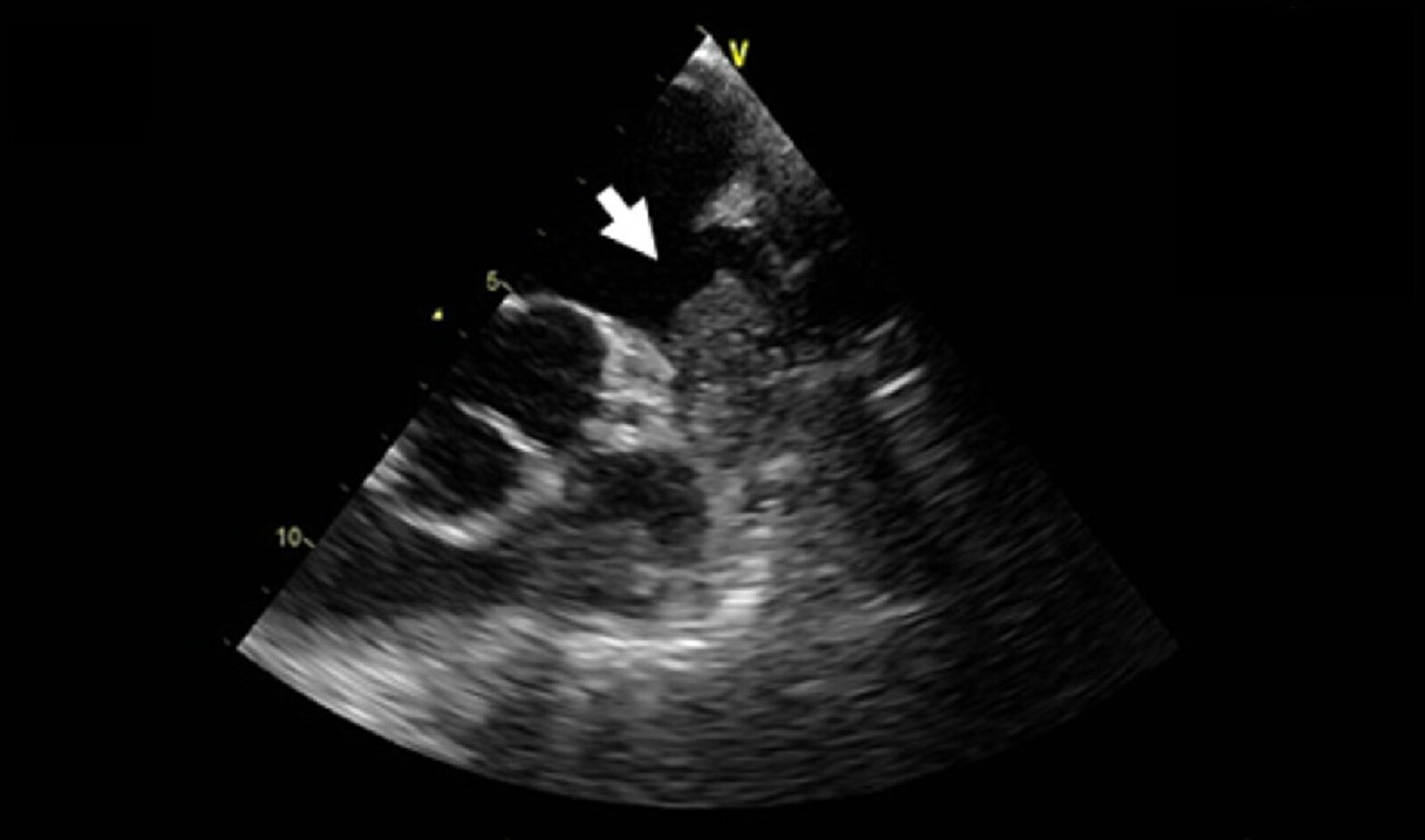 Thrombus in the left atrial appendage