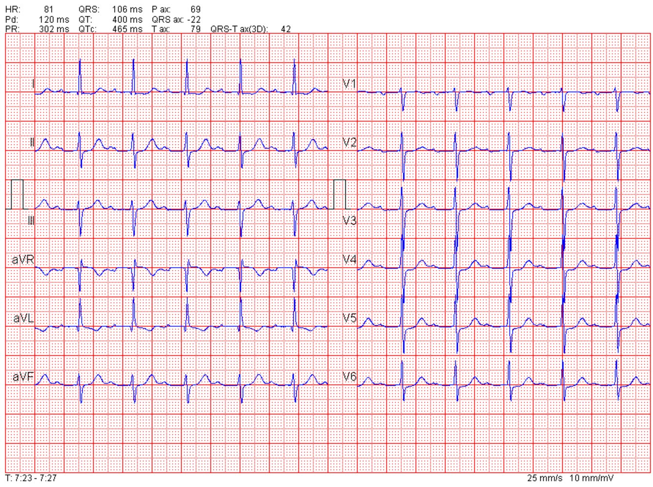First-degree atrioventricular block
