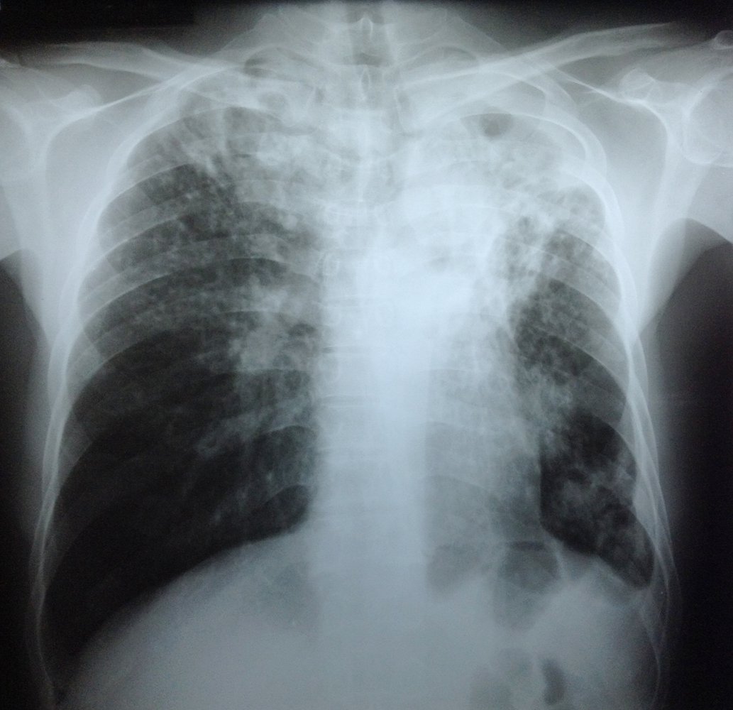 Post-primary tuberculosis