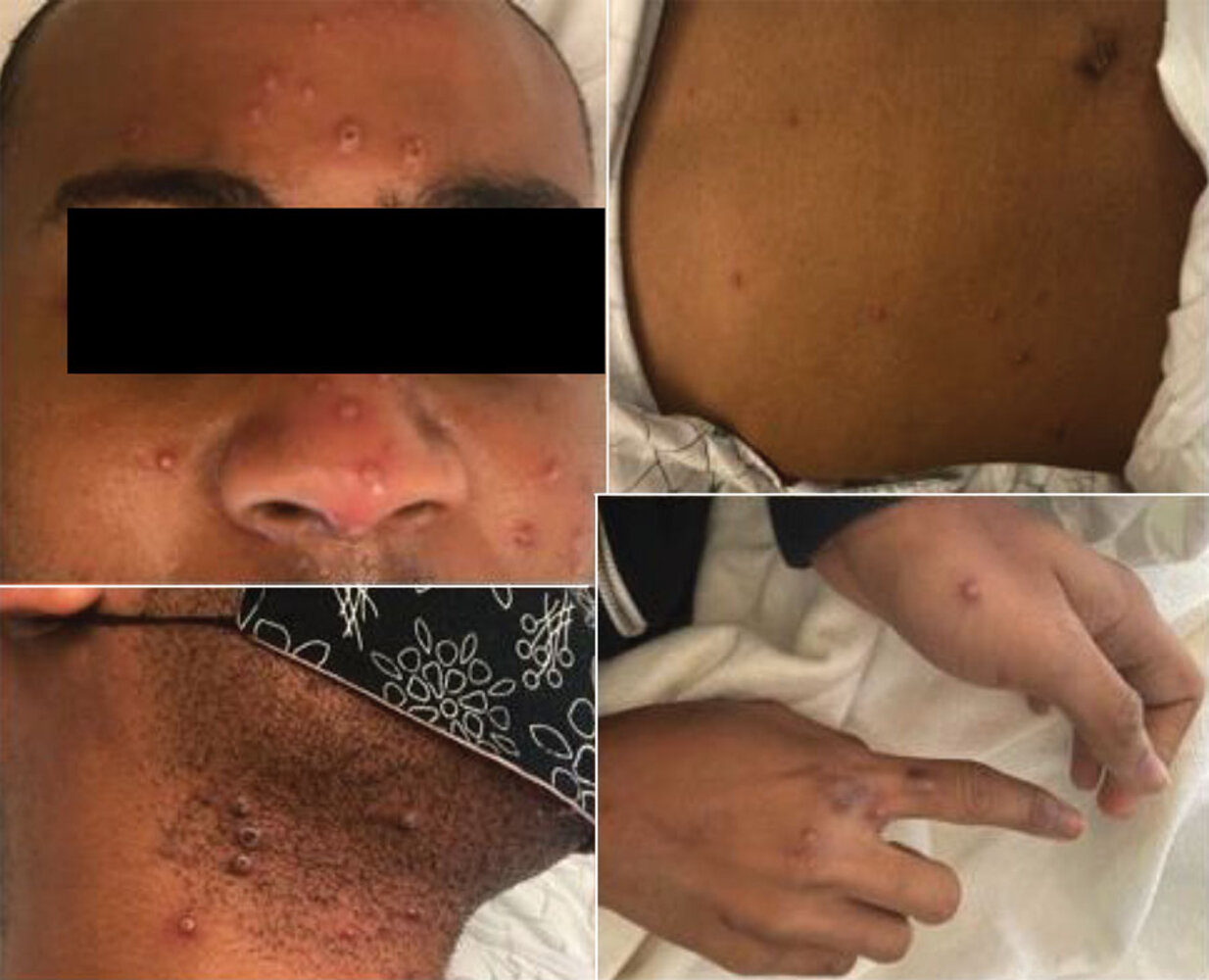 Mpox