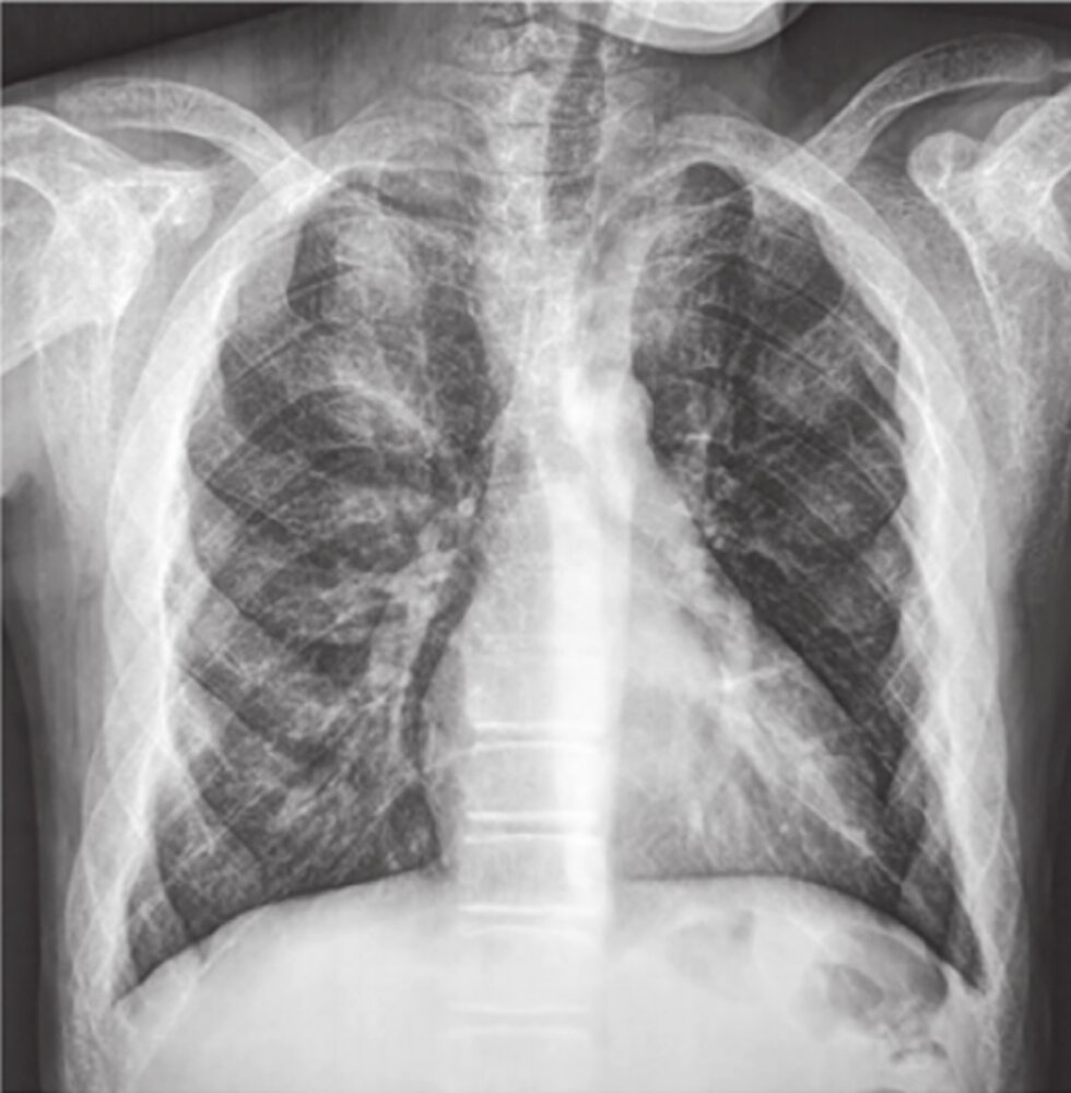 Rib-within-a-rib sign in thalassemia