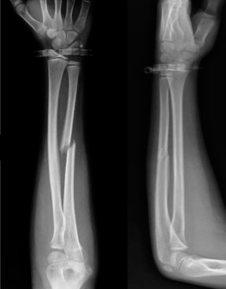 Ulnar shaft fracture