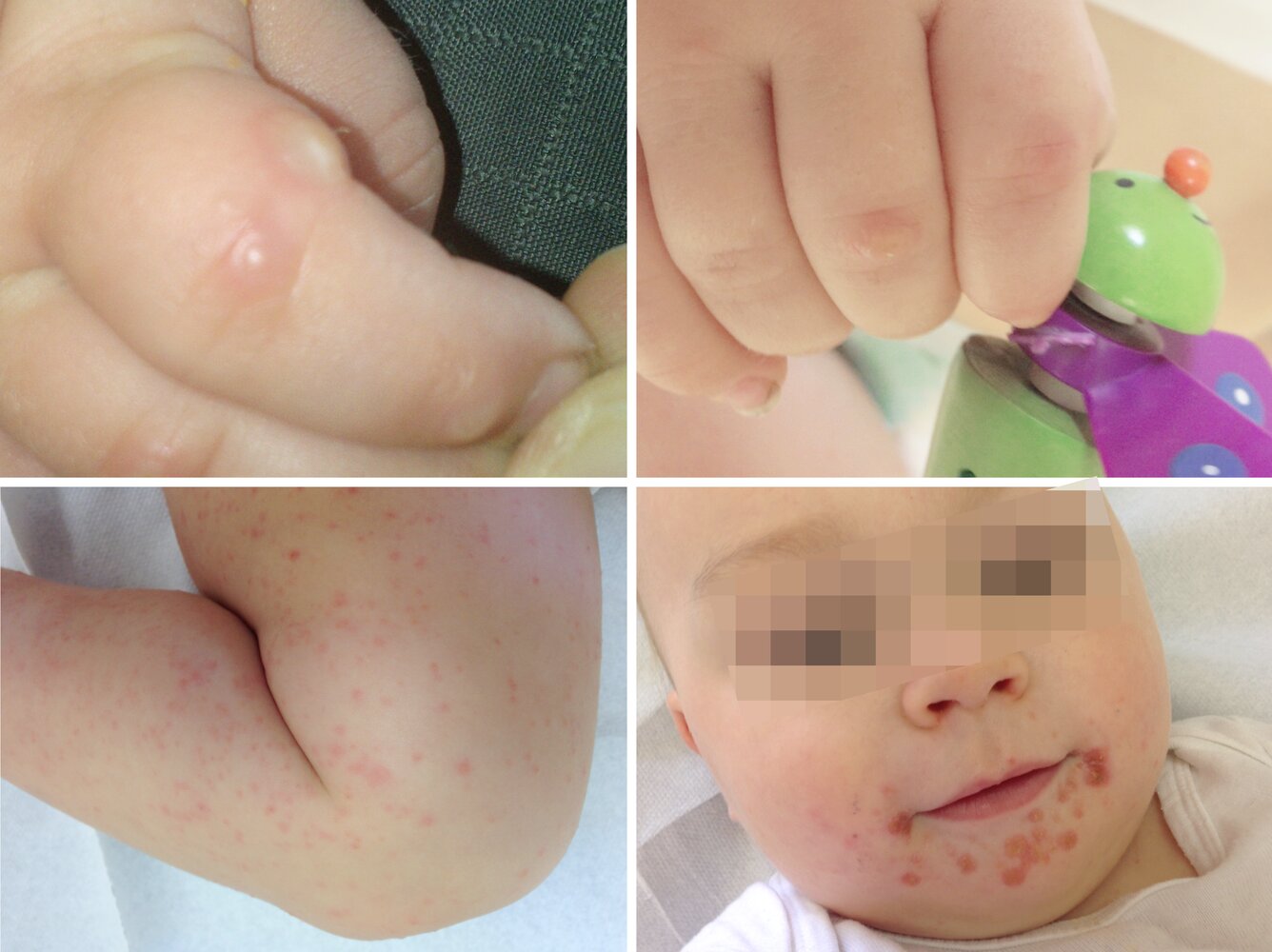 Hand, foot, and mouth disease